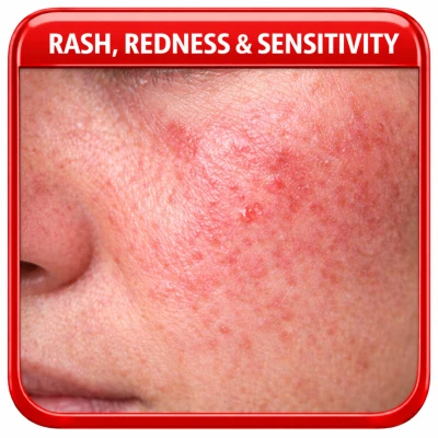 Rash, Redness & Sensitivity