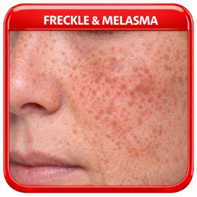 Freckles & Melasma